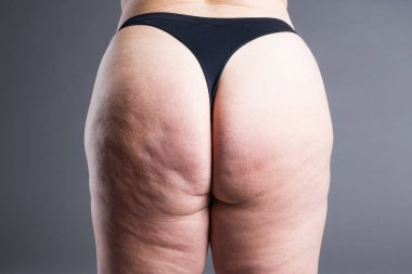 Selülit, kilolu sırt, kalça ve kalça gri arka plan, arka görüş ile şişman kadın bedeni