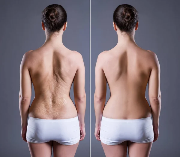 Woman Large Scar Back Concept Rear View Gray Background — Stock Photo, Image