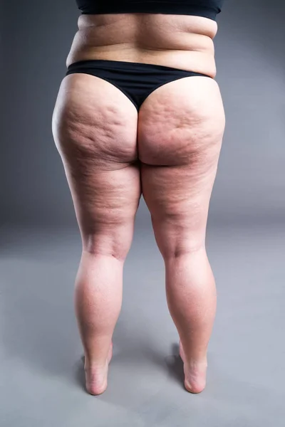 Grasso Corpo Femminile Con Cellulite Schiena Sovrappeso Fianchi Glutei Sfondo — Foto Stock