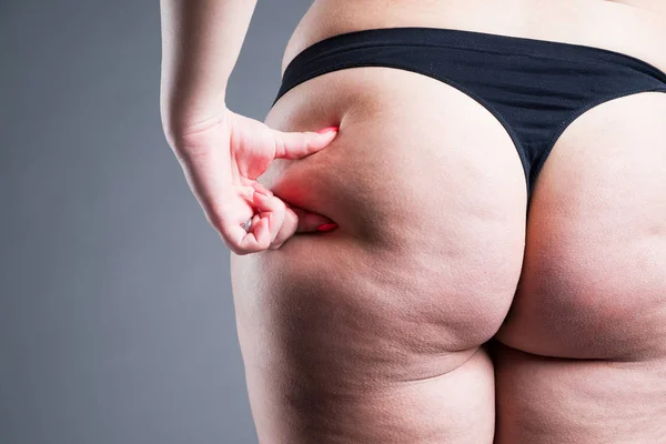 Vet Vrouwelijk Lichaam Met Cellulitis Overgewicht Heupen Billen Grijze Achtergrond — Stockfoto