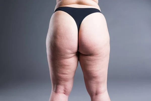 Fedt Kvindelig Krop Med Cellulite Overvægtige Ryg Hofter Balder Grå - Stock-foto