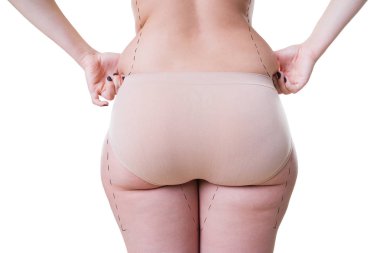 Kadın holding kat deri, selülit beyaz arka plan üzerinde atış studio izole kadın bedeni üzerinde