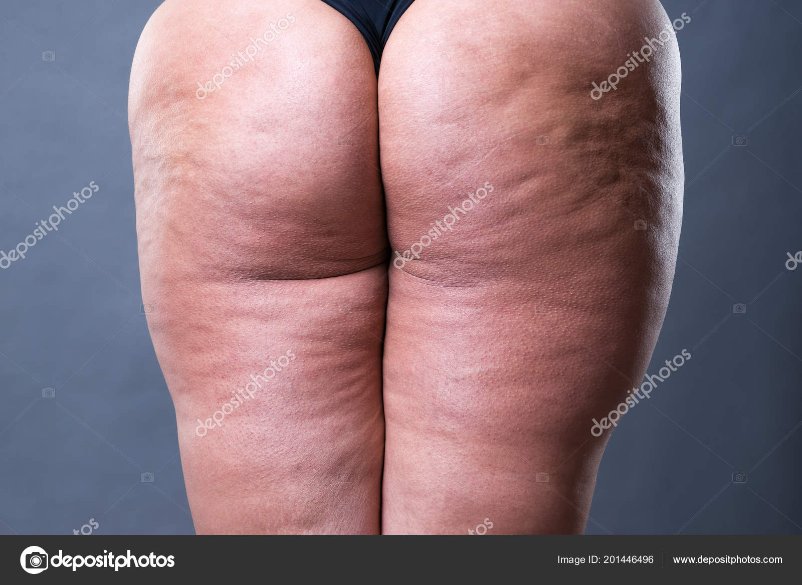 Fat Cellulite Butts Fat Cellulite Butts