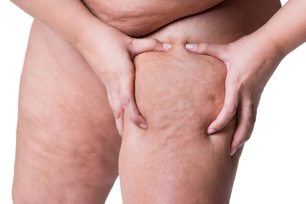 Femme Surpoids Avec Des Cuisses Grasses Obésité Jambes Féminines Isolées — Photo