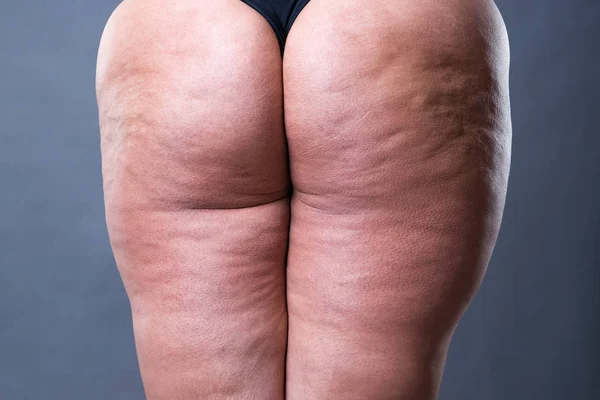 Grasso Corpo Femminile Con Cellulite Schiena Sovrappeso Fianchi Glutei Sfondo — Foto Stock