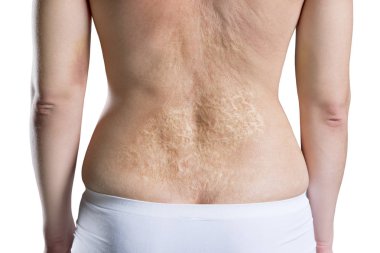 Kadın yanık beyaz arka plan üzerinde izole arka, arka görünümünde, sonra büyük bir yara izi ile