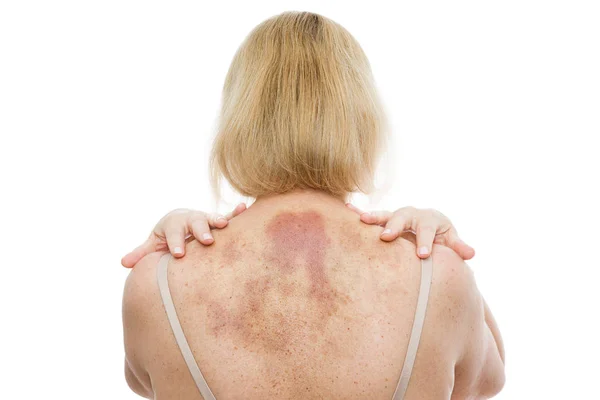 Ett Blåmärke Baksidan Kvinna Med Omfattande Hematom Efter Massage Isolerad — Stockfoto