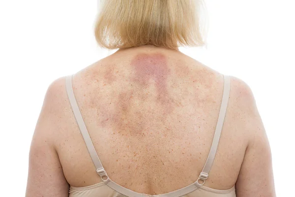 背部擦伤 按摩后有广泛血肿的妇女 在白色背景下被隔离 — 图库照片