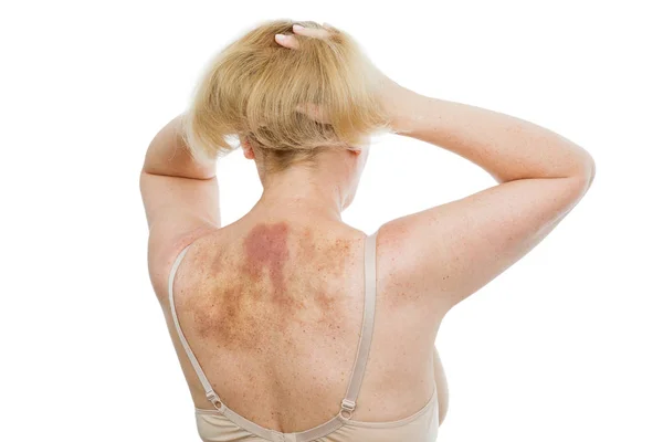 Ett Blåmärke Baksidan Kvinna Med Omfattande Hematom Efter Massage Isolerad — Stockfoto