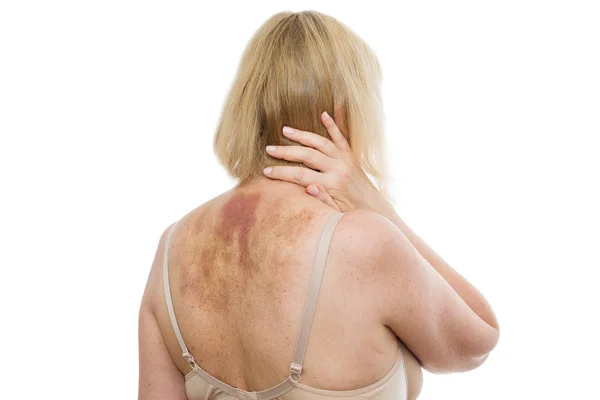 Una Contusión Espalda Una Mujer Con Hematoma Extenso Después Masaje — Foto de Stock