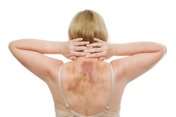 Eine Prellung Rücken Eine Frau Mit Ausgedehnten Hämatomen Nach Einer — Stockfoto