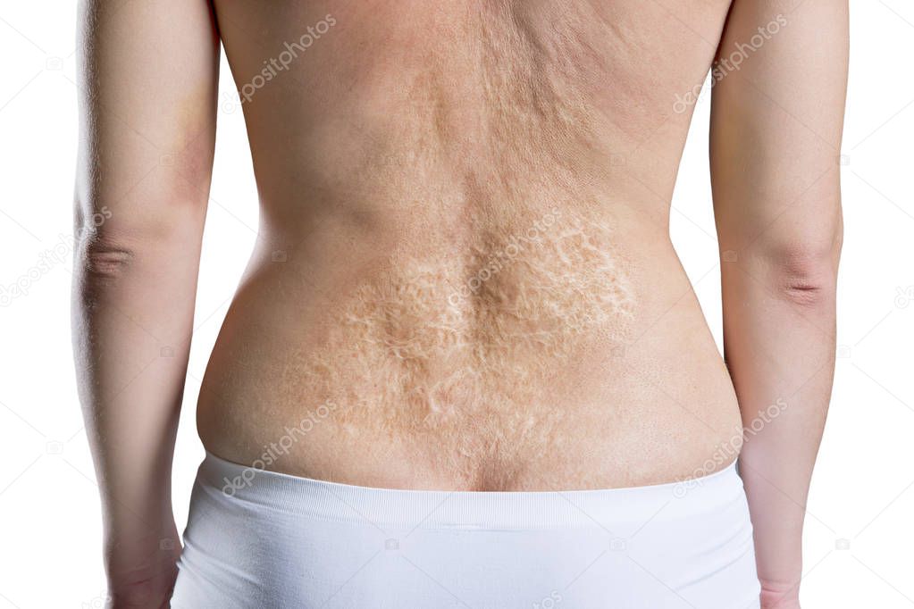 Woman with a large scar after burn on the back, rear view, isolated on white background