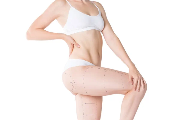 Liposuccion Graisse Concept Élimination Cellulite Corps Féminin Surpoids Avec Lignes — Photo