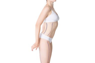 Liposuction, yağ ve selülit kaldırma kavramı, boyalı çizgileri ve beyaz arka plan üzerinde izole okları, kilolu kadın bedeni