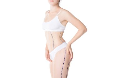 Liposuction, yağ ve selülit kaldırma kavramı, boyalı çizgileri ve beyaz arka plan üzerinde izole okları, kilolu kadın bedeni