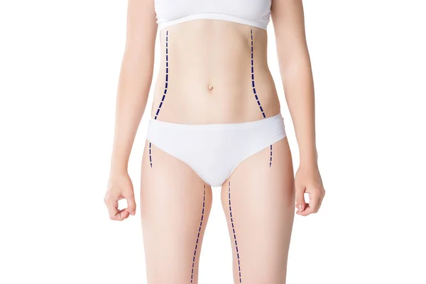 Conceito Lipoaspiração Remoção Gordura Celulite Corpo Feminino Com Excesso Peso — Fotografia de Stock