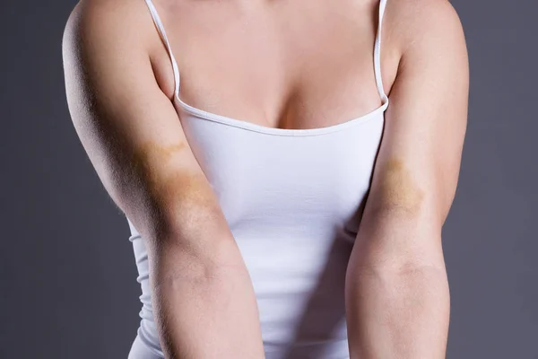 Bruises Woman Hands Arms Extensive Hematoma Gray Background — Stock Photo, Image