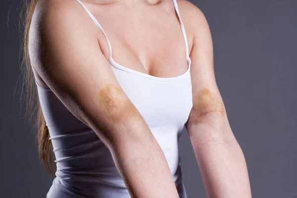 Bruises Woman Hands Arms Extensive Hematoma Gray Background — Stock Photo, Image