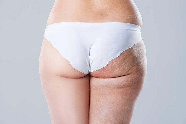 Overweight woman with fat cellulite legs and buttocks, before after concept, obesity female body isolated on white background, rear view