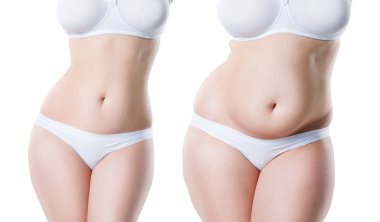 Kadın vücudu önce ve sonra beyaz arka plan üzerinde plastik cerrahi kavramı izole kilo kaybı