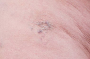 Varicose veins closeup, skin spider on the human body clipart