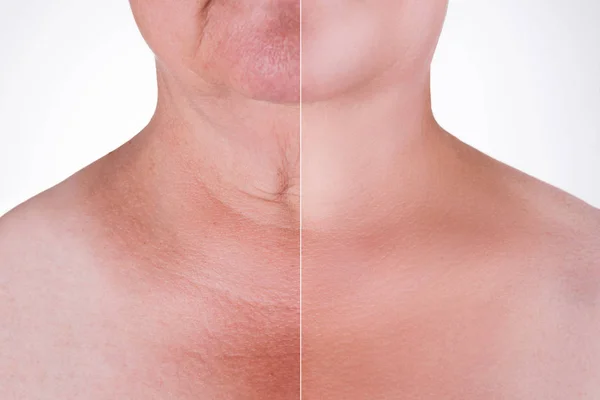 Rejuvenescimento da pele no pescoço, antes após o conceito anti envelhecimento, tratamento de rugas, facelift e cirurgia plástica — Fotografia de Stock