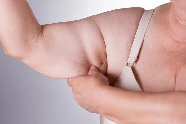 Slappe huid op de arm van een vrouw — Stockfoto