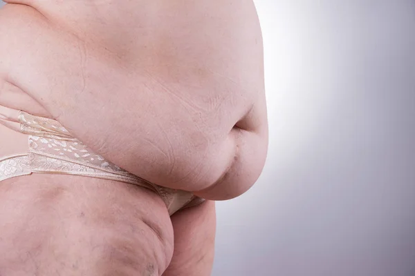 Tummy tuck, flabby skin on a fat belly, plastic surgery concept