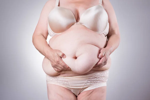 Abdominoplastia, piel flácida en un vientre gordo, concepto de cirugía plástica — Foto de Stock