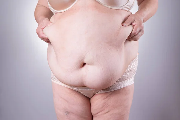 Abdominoplastia, piel flácida en un vientre gordo, concepto de cirugía plástica —  Fotos de Stock