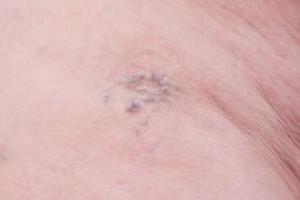 Varicose veins closeup, skin spider on the human body — Stock Photo, Image