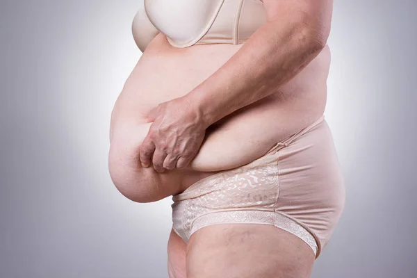 Tummy Tuck, slappe huid op een dikke buik, plastische chirurgie concept — Stockfoto