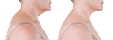 Boyun cilt gençleştirme, anti-aging kavramı, kırışıklık tedavisi, facelift ve plastik cerrahi sonra önce