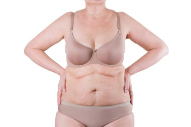 Tummy Tuck, yağlı göbek üzerinde gevşek cilt, plastik cerrahi kavramı