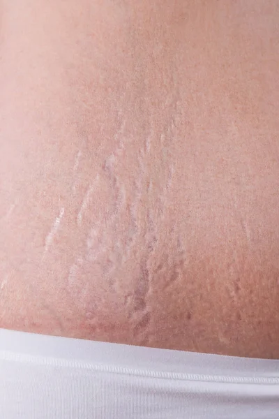 Female belly with stretch marks closeup — Stock Photo, Image