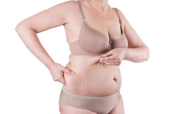 Abdominoplastia, piel flácida en un vientre gordo, concepto de cirugía plástica —  Fotos de Stock