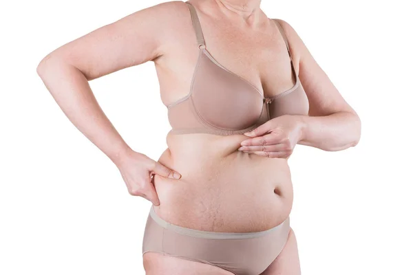 Abdominoplastia, piel flácida en un vientre gordo, concepto de cirugía plástica — Foto de Stock