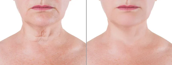 Rejuvenescimento da pele no pescoço, antes após o conceito anti envelhecimento, tratamento de rugas, facelift e cirurgia plástica — Fotografia de Stock