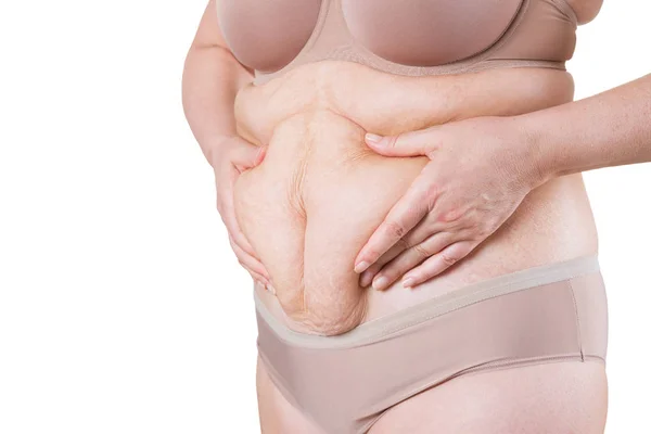 Abdominoplastia, piel flácida en un vientre gordo, concepto de cirugía plástica — Foto de Stock