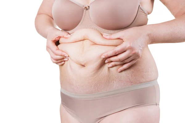 Tummy Tuck, slappe huid op een dikke buik, plastische chirurgie concept — Stockfoto