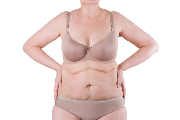 Tummy tuck, peau flasque sur un ventre gras, concept de chirurgie plastique — Photo