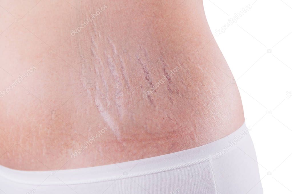 Female belly with stretch marks isolated on white background