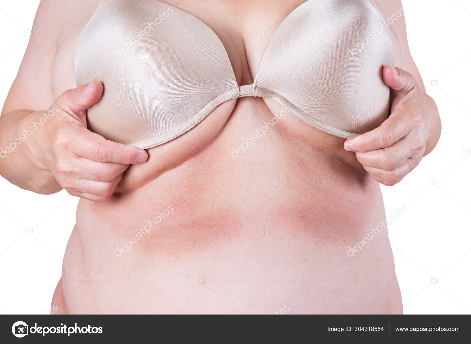 Old woman with irritated skin under bra, irritation on the body