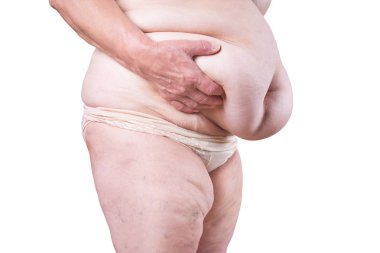 Göbeğinde sarkık deri, beyaz arka planda izole edilmiş plastik cerrahi konsepti.