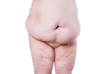 Göbeğinde sarkık deri, beyaz arka planda izole edilmiş plastik cerrahi konsepti.