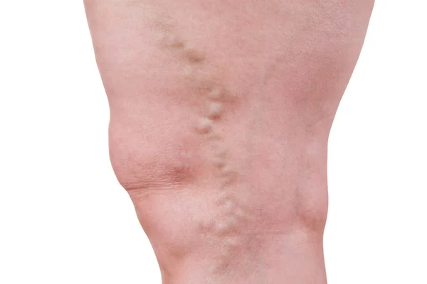 Venas varicosas primer plano, piernas hembras gordas aisladas sobre fondo blanco —  Fotos de Stock