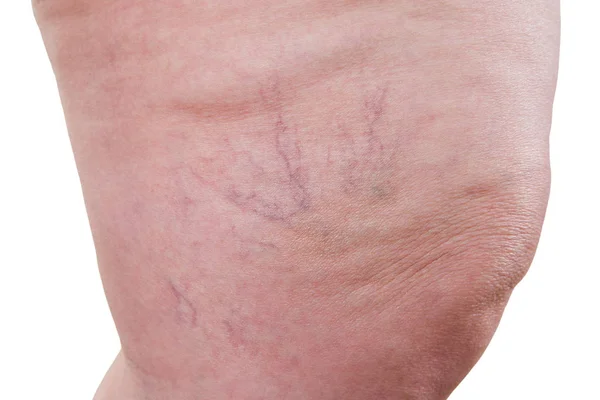 Varizes veias closeup, gordura pernas femininas isoladas no fundo branco — Fotografia de Stock