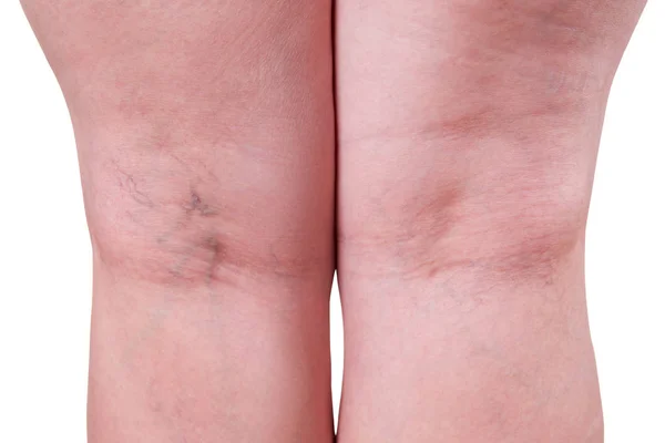 静脈瘤のクローズ アップ、白い背景で隔離太った女性の脚 — ストック写真