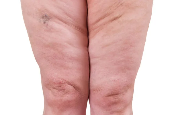 Venas varicosas primer plano, piernas hembras gordas aisladas sobre fondo blanco — Foto de Stock
