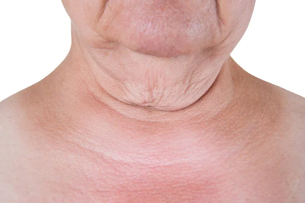 Flabby skin on the neck of an elderly woman isolated on white background — Stock Photo, Image